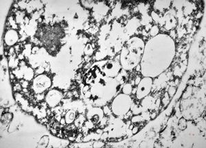 M,46y. | Entamoeba histolytica